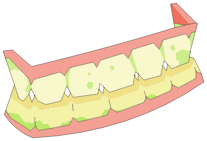 Dentier de Porkass